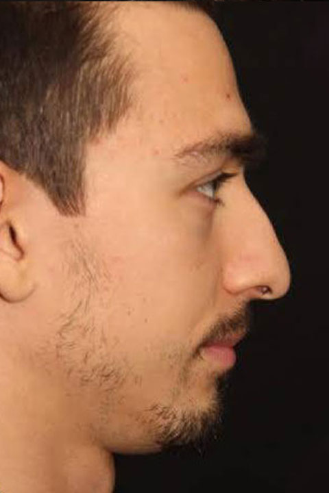 Nasal contour before rhinoplasty