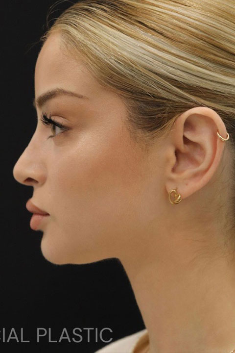 Profile after rhinoplasty