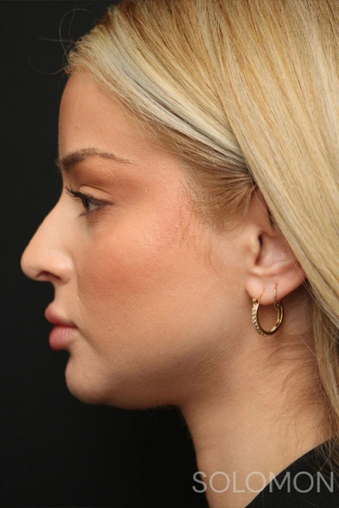 Profile before rhinoplasty