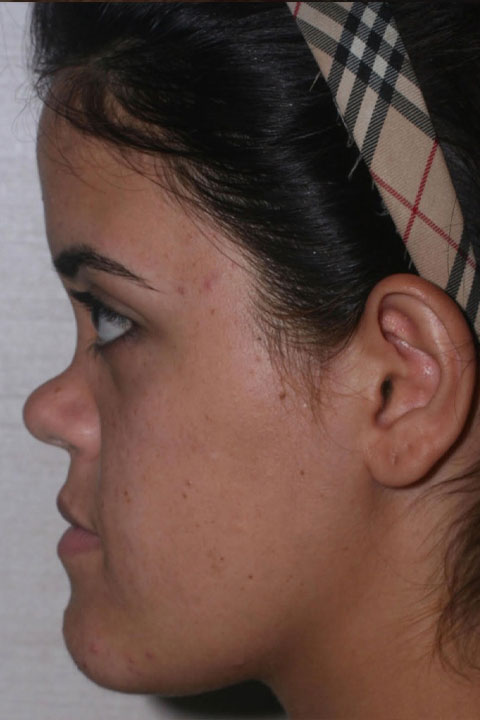 Nose profile before surgery
