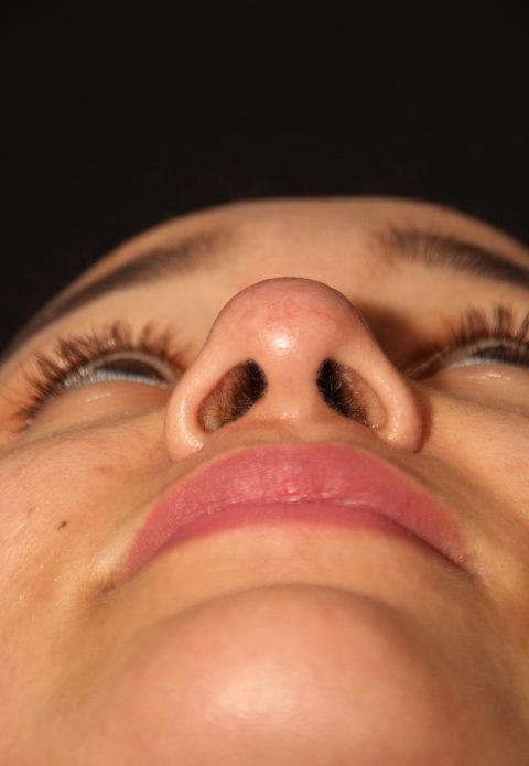 Female patient after nasal tip
