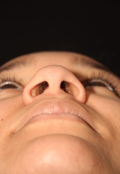 Female patient before nasal tip