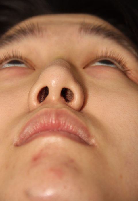 Male patient before nasal tip