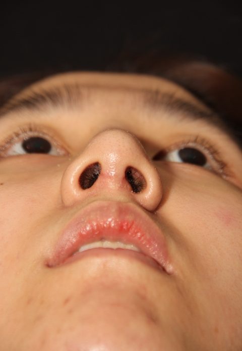Male patient after nasal tip