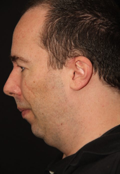 Male patient before rhino chin implant
