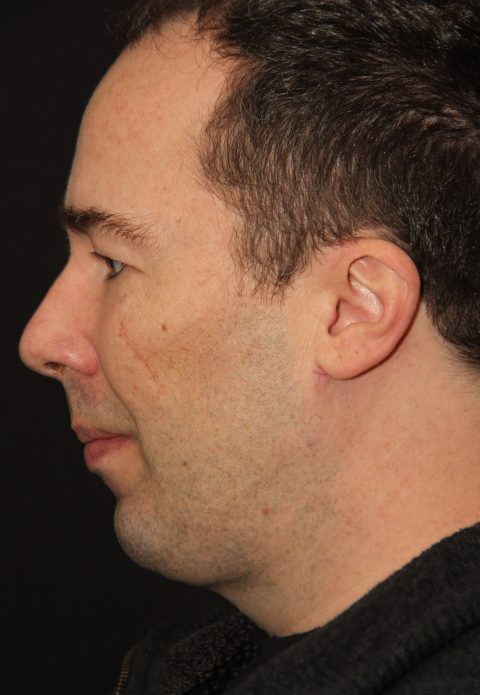 Male patient after rhino chin implant