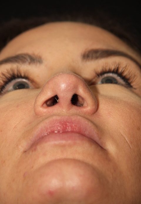 Female patient after nasal tip