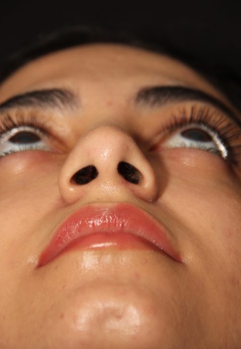 Female patient after nasal tip