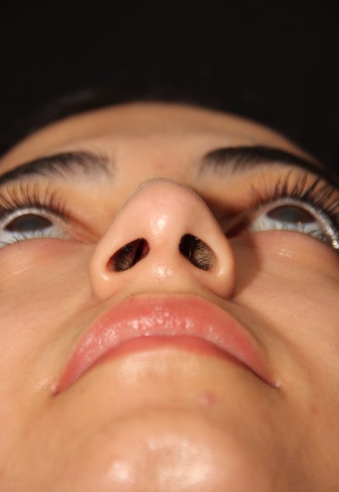 Female patient before nasal tip