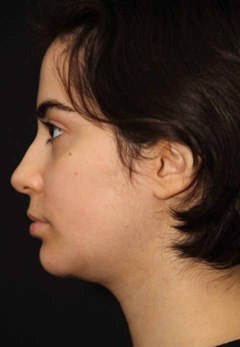 Female patient after rhino chin implant