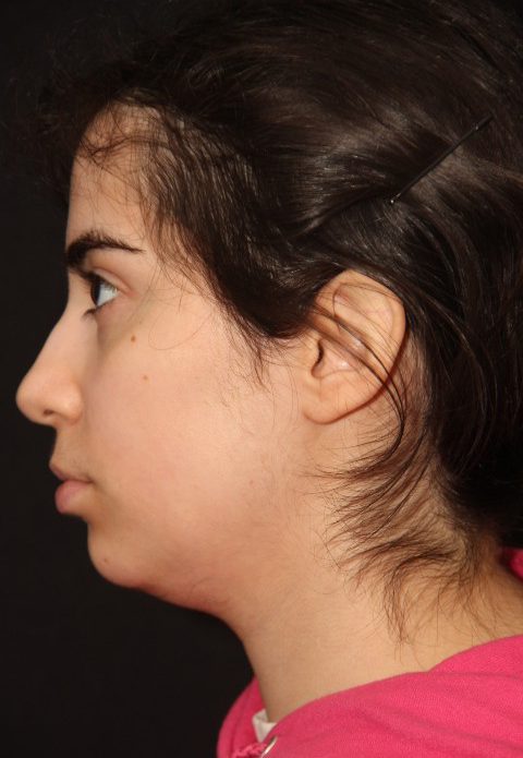 Female patient before rhino chin implant