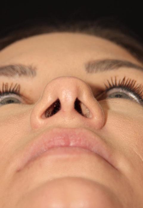 Female patient before nasal tip